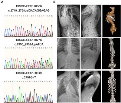 Variants Affecting the C-Terminal of CSF1R Cause Congenital Vertebral Malformation Through a Gain-of-Function Mechanism